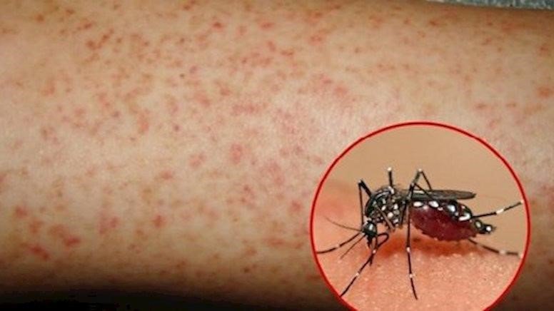 muỗi vằn gây bệnh sốt xuất huyết