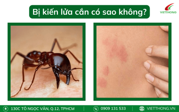 Bị Kiến Lửa Cắn Mẹo Xử Lý Không để Lại Sẹo An Toàn Tại Nhà